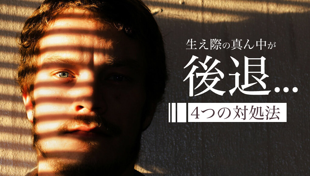 生え際が真ん中から後退したけど、4つの対処法で前髪が復活した